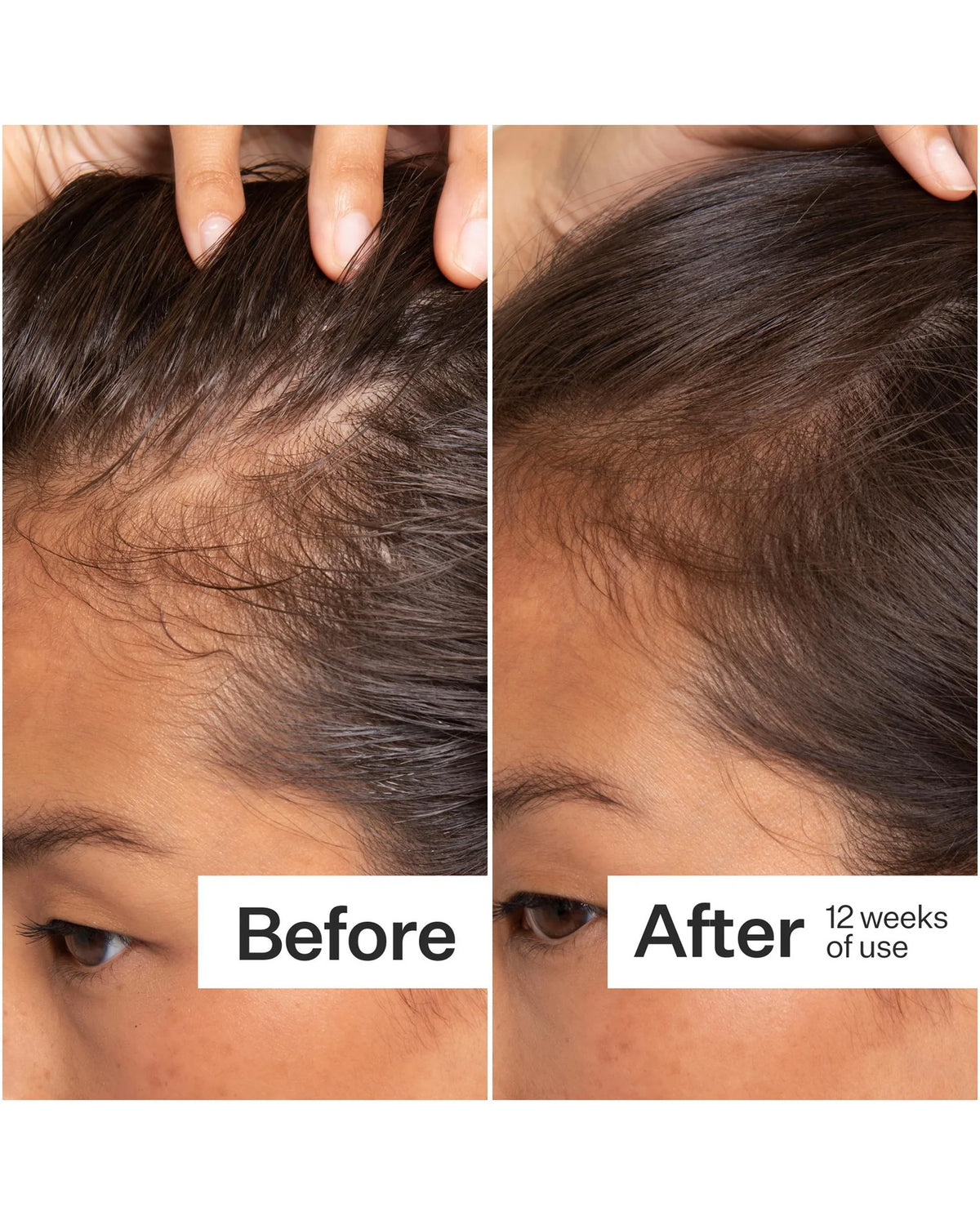 Act + Acre Scalp Serum NCOL